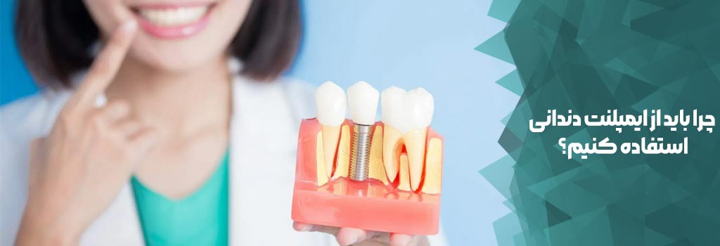 چرا باید از ایمپلنت دندانی استفاده کنیم؟